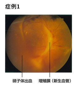 糖尿病症例